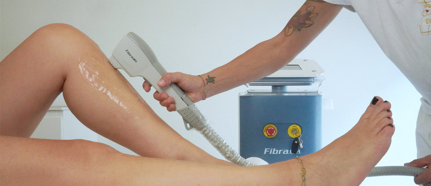 epilazione fibra laser